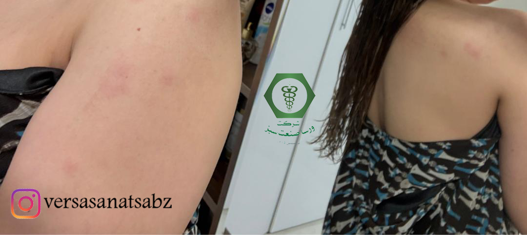 علایم گزش ساس، آثار گزش ساس، اثرات گزش ساس، نشانه های گزش ساس